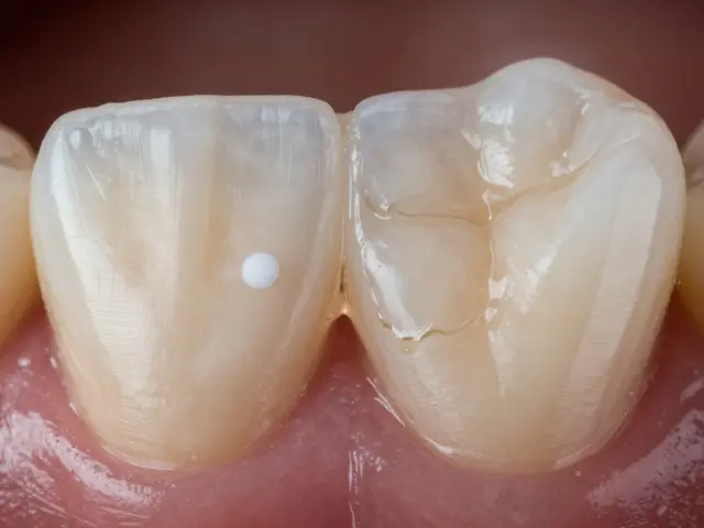 Co způsobuje kazivost zubu? Pravdy, které vám dentisté neřeknou