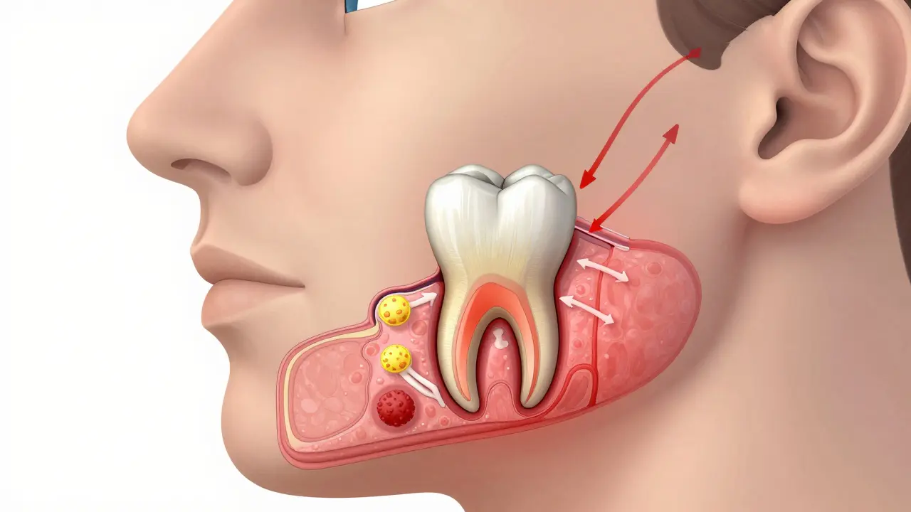 Průřez čelistí s infikovaným zubem a šířením zánětu do okolních tkání.