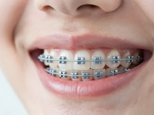 Jaká barva je nejlepší na rovnátka? Průvodce výběrem barev pro keramická a kovová zařízení